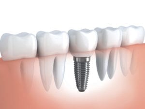 The Importance of Replacing Missing Teeth