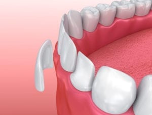 Porcelain Veneers in Manhattan NY