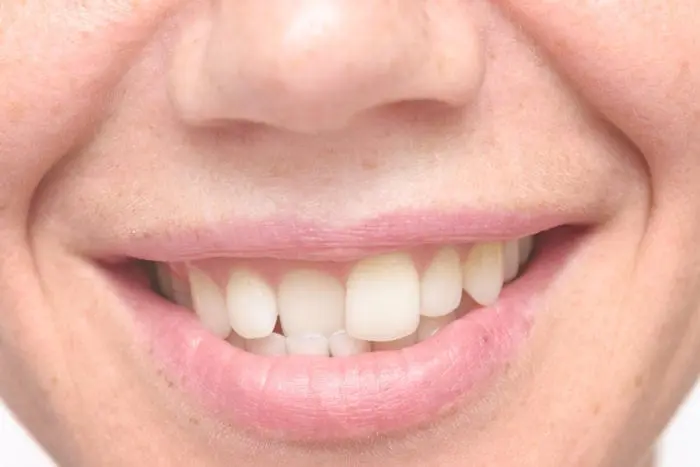 straighten teeth in Manhattan and Larchmont New York