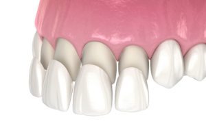 Veneer installation procedure over central incisor and lateral incisor cosmetic dentistry dentist in Manhattan New York